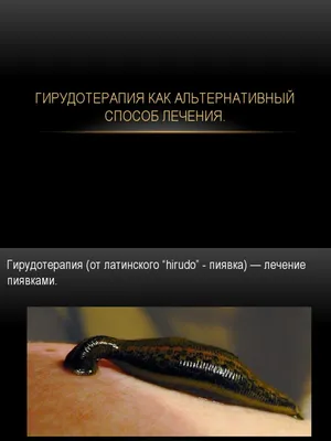Гирудотерапия
