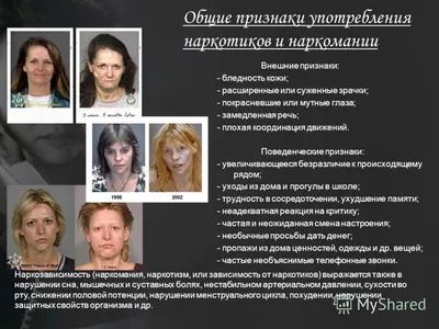 Глаза наркомана, как признак употребления наркотиков — pro-zavisimost.ru