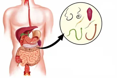 Глисты: причины появления, методы лечения и профилактики