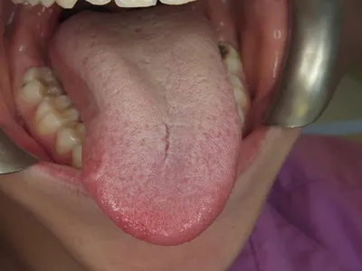 Ромбовидный глоссит: обзор клинического случая - parodont.pro