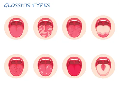Глоссит | Стоматология Бескудниково