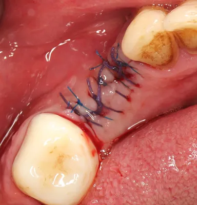 Like-Dent - ✓Под коронкой портится зуб? ⠀ Под коронкой ни гниение, ни  разрушение зуба невозможно в принципе, коронка и надевается для того, чтобы  не дать зубу разрушиться. • Сначала зуб максимально укрепляется,