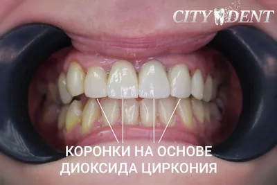 Дырка В Зубе Сбоку Болит Чем Заделать ЛюмиДент