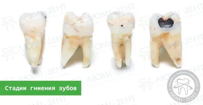 Неприятный запах из-под коронки - причины, симптомы, методы лечения