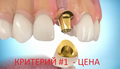 Стоматология 32 | Бишкек on Instagram: \"5 мифов о зубных коронках.⤵️ ⠀ 1.  \"Под коронкой зуб гниет\" ⠀ ▫️Гниение - это инфекция, кариес, который  остается без лечения. А откуда кариес под коронкой?
