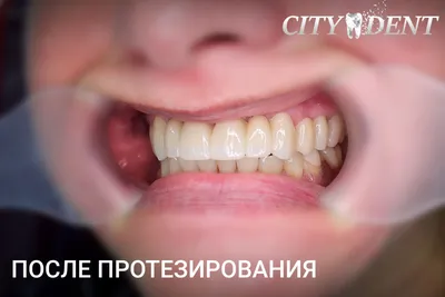 Гнилые зубы - причины, как лечить, последствия — ROOTT