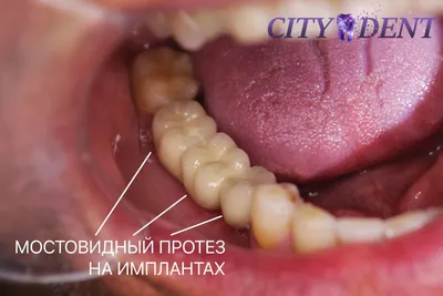 Лечение кариеса – Стоматология CITY DENT