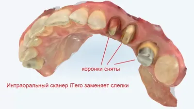 Что важно знать об удалении зубов - особенности удаления и сложности  лечения зубов