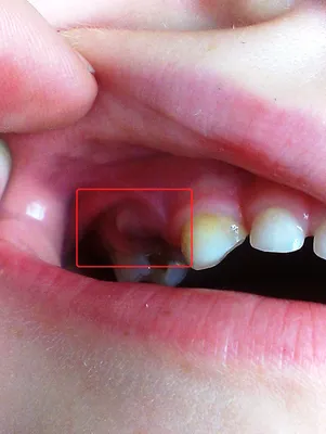 Гнояться ясна після видалення зуба — 4 причини, 5 симптомів і лікування |  Dental Art