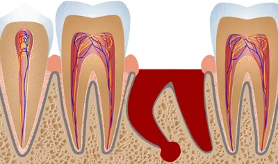 Заживление лунки после удаления зуба - этапы, симптомы и возможные  осложнения, рекомендации