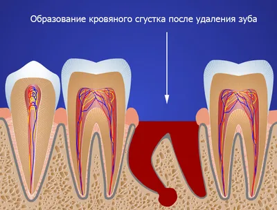 Нагноение после удаления зуба
