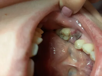 Удаление зуба с гранулемой - Вопрос стоматологу - 03 Онлайн