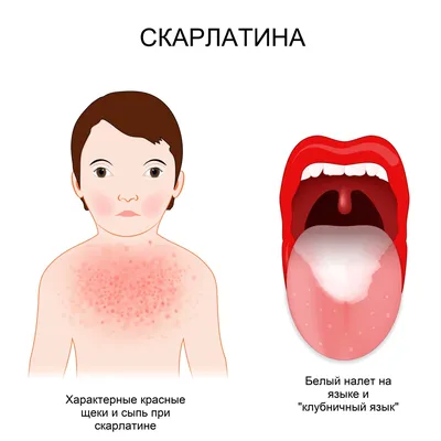 Скарлатина у взрослых: признаки, симптомы, диагностика, как передается,  лечение