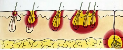 Гнойничковые заболевания кожи - презентация онлайн