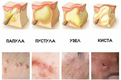Прыщи на лобке и половых губах у женщин: диагностика и лечение - Газета.Ru