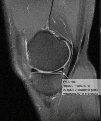 Расшифровка МРТ коленного сустава. Горизонтальный разрыв заднего рога  медиального мениска. Частичный субтотальный разрыв передней крестообразной  связки | Второе мнение