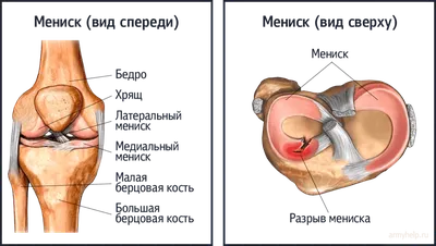 Разрыв мениска и армия в 2024 году