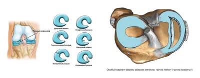 МРТ-диагностика разрывов менисков коленного сустава