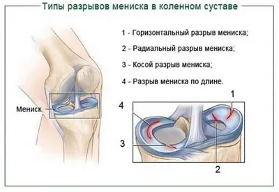 Травмы и заболевания коленного сустава Артроскопическая менискэктомия  (резекция мениска)