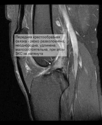 Разрыв мениска: причины, симптомы и лечение в статье травматолога Сапунков  С. А.