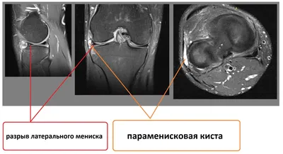 МРТ-диагностика разрывов менисков коленного сустава