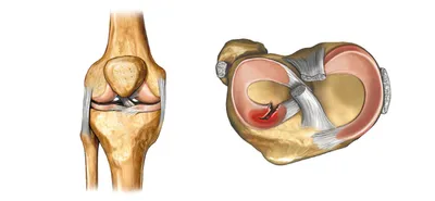 Разрыв мениска - Медицинский центр \"Мирт\"