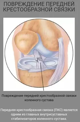 Расшифровка МРТ коленного сустава. Горизонтальный разрыв заднего рога  медиального мениска. Частичный субтотальный разрыв передней крестообразной  связки | Второе мнение