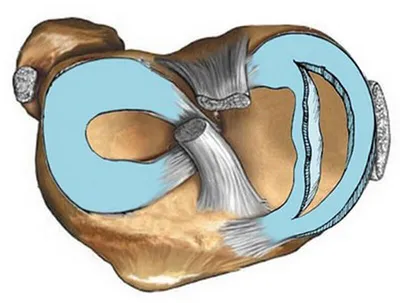 РАЗРЫВ рога медиального МЕНИСКА на РАСШИФРОВКЕ МРТ коленного сустава. Разрыв  медиального мениска - YouTube