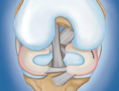 Разрыв заднего рога медиального мениска: горизонтальные повреждения и  дегенеративные изменения