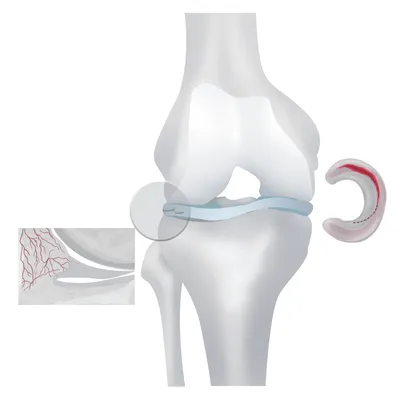 Разрыв мениска - Клиника 29