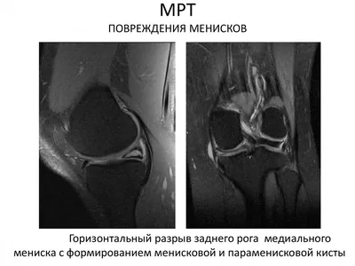 Мениски - причины повреждения