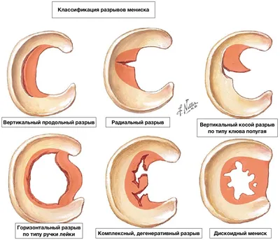 Классификации разрывов мениска — 24Radiology.ru