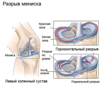 Разрыв мениска - признаки, причины, симптомы, лечение и профилактика -  iDoctor.kz