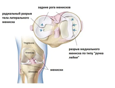 Операция при разрыве мениска | Фото до и после, операция, отзывы, лечение,  реабилитация и восстановление