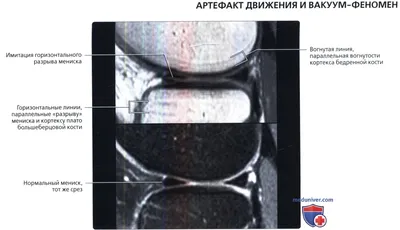 Мениск и Co. Травмы колена. - Форум onliner.by