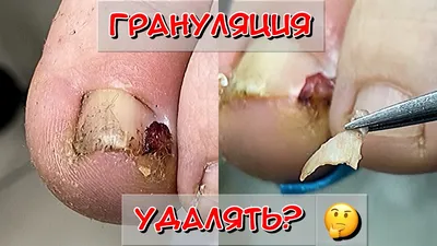 Ортониксия в СПб, лечение вросших ногтей: цены, врачи, противопоказания