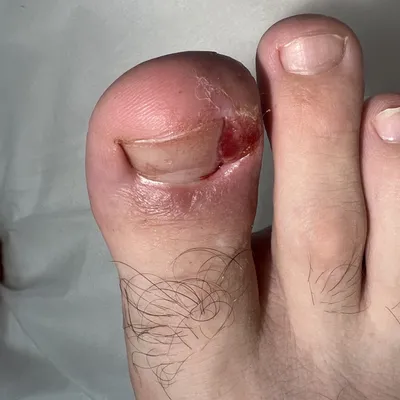 Podolog_olga - ⠀ Онихолизис - отслоение ногтевой пластины от ногтевого  ложа. ⠀ Онихолизис не болит. Но! ⠀ 🛑Подвижная отслоившаяся часть ногтевой  пластины постоянно травмирует ногтевое ложе, особенно при ношении обуви.  При этом,