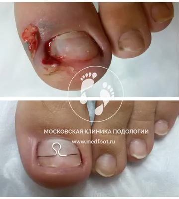 Светлана Литвин🌱Подолог🌱инструктор по ортониксии🌱ЯЛТА on Instagram: \"📌  Пиогенная гранулема — самое распространенное сосудистое поражение ногтевого  аппарата. Это эруптивная ангиома, которая может появляться на любом участке  ногтя в результате ...