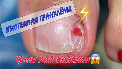 Гранулема ногтя – это... - Nail Academy by Tatjana Tkachenko | Facebook