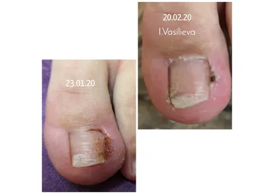 Лечение вросшего ногтя на большом пальце ноги, операция по удалению  вросшего ногтя на ногах