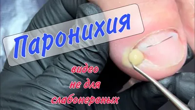Протезирование ногтей на ногах, восстановление ногтевой пластины ✓ Клиника  подологии Полёт в Москве