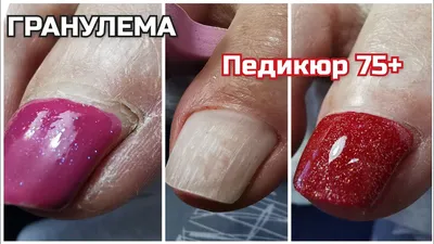 Пиогенная гранулема