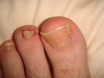 Ingrown toenail / The nail grows back after surgery - YouTube