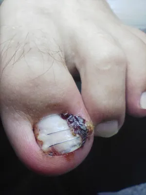 Избавление от онихорексиса (продольное расслоение) ногтевой пластины в  Центре подологии СТОПАМЕР