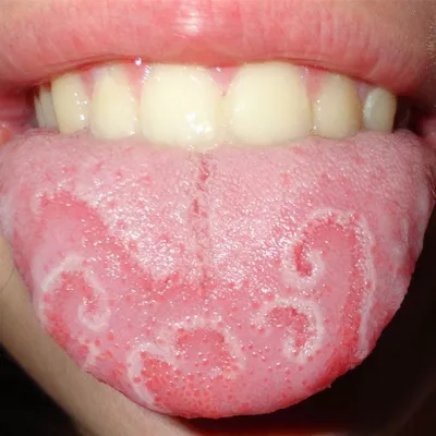 Грибковые заболевания полости рта фотографии