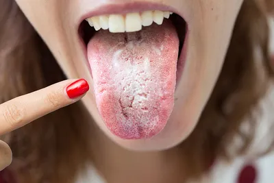 [37+] Грибковые заболевания полости рта фото