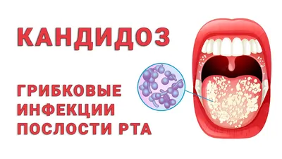 oral candidiasis - YouTube