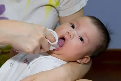 Кандидоз во рту у ребенка - статьи детской стоматологической поликлиники  «Мартинка»