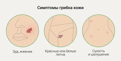 Грибок на пальцах ног - причины, симптомы, лечение микоза.