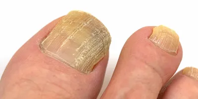 Эффективное лечение грибка ногтей - meds.ru
